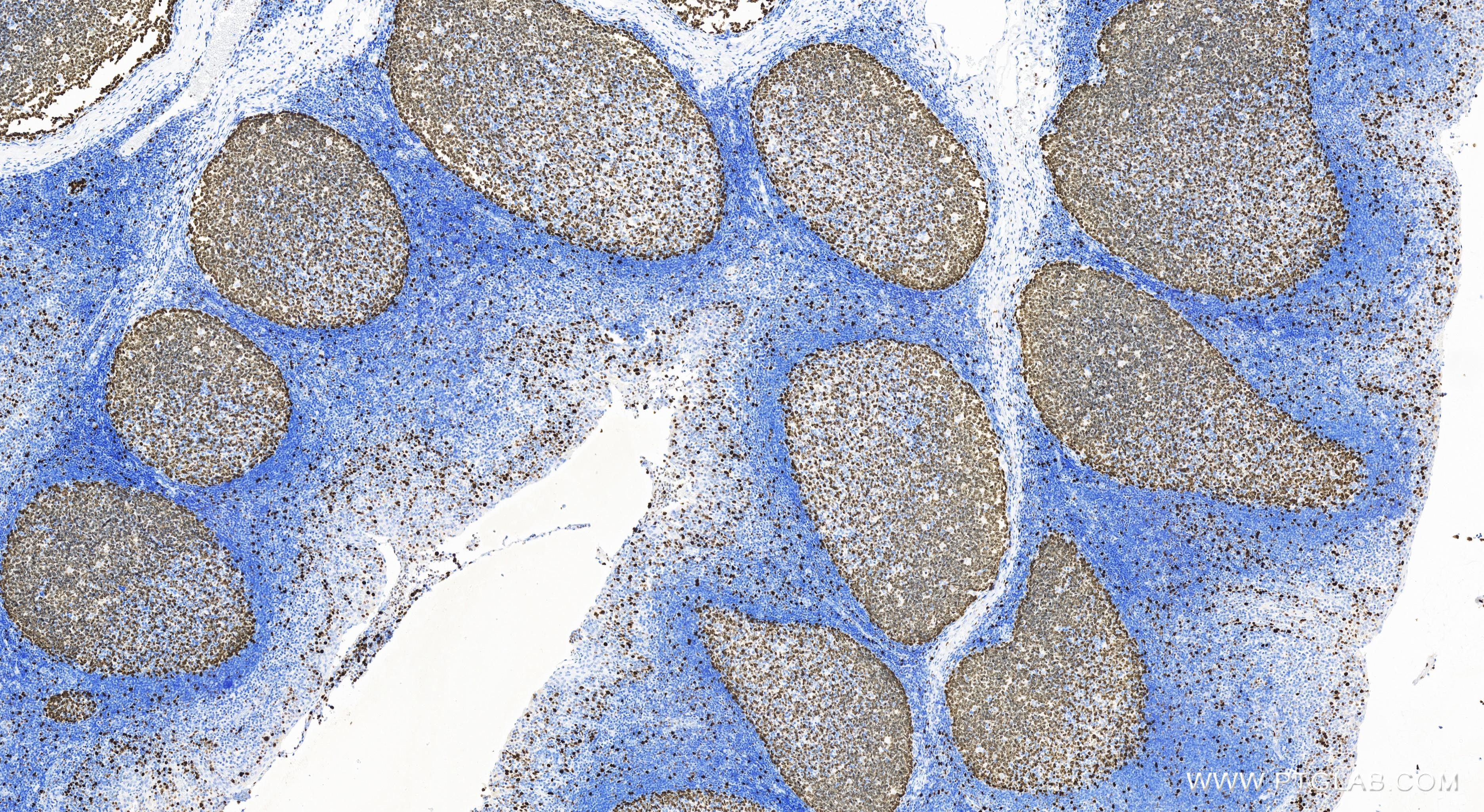 Immunohistochemistry (IHC) staining of human tonsillitis tissue using KI67 Recombinant antibody (84192-3-RR)