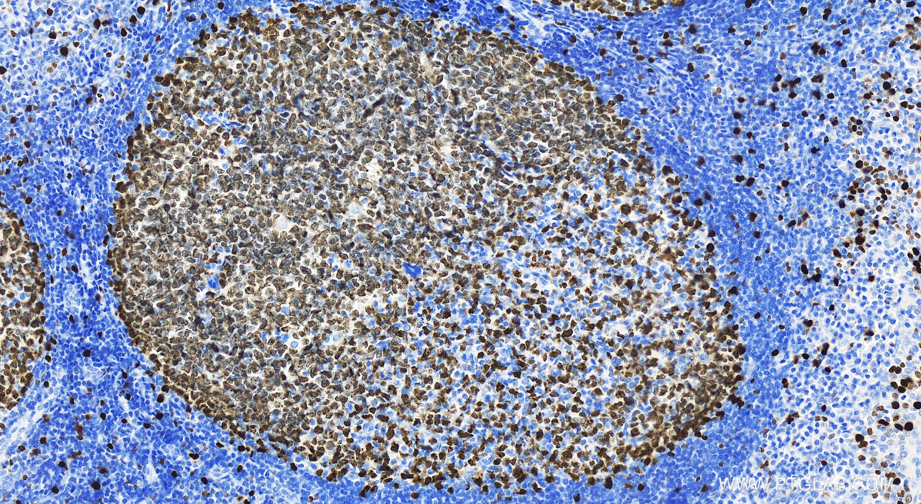 Immunohistochemistry (IHC) staining of human tonsillitis tissue using KI67 Recombinant antibody (84192-3-RR)