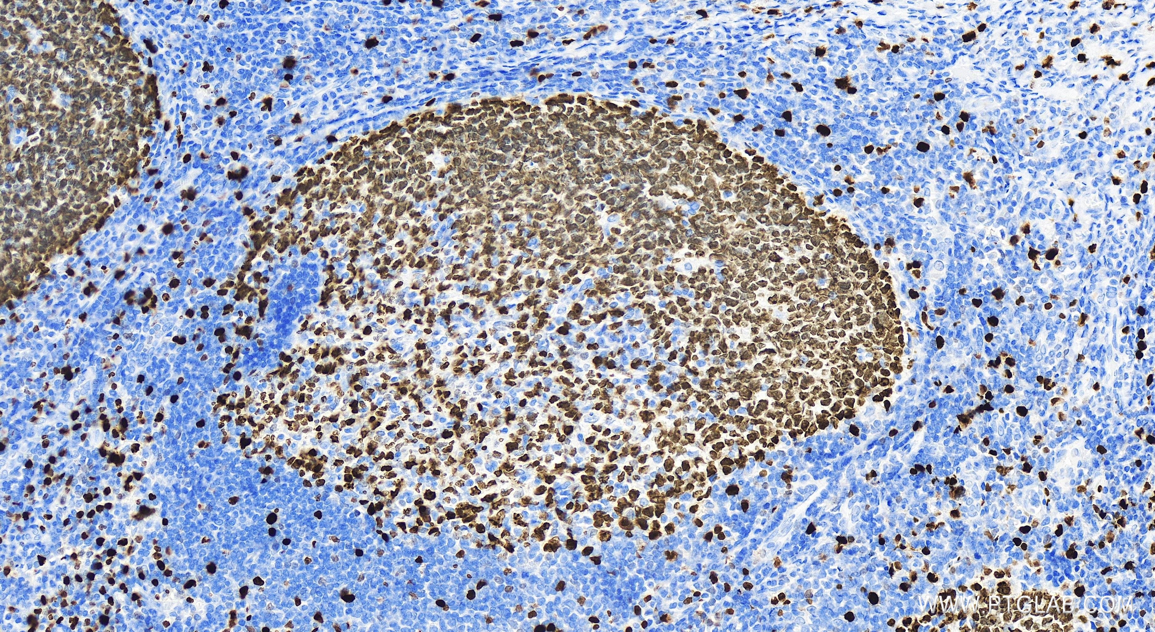 Immunohistochemistry (IHC) staining of human tonsillitis tissue using KI67 Recombinant antibody (84192-3-RR)