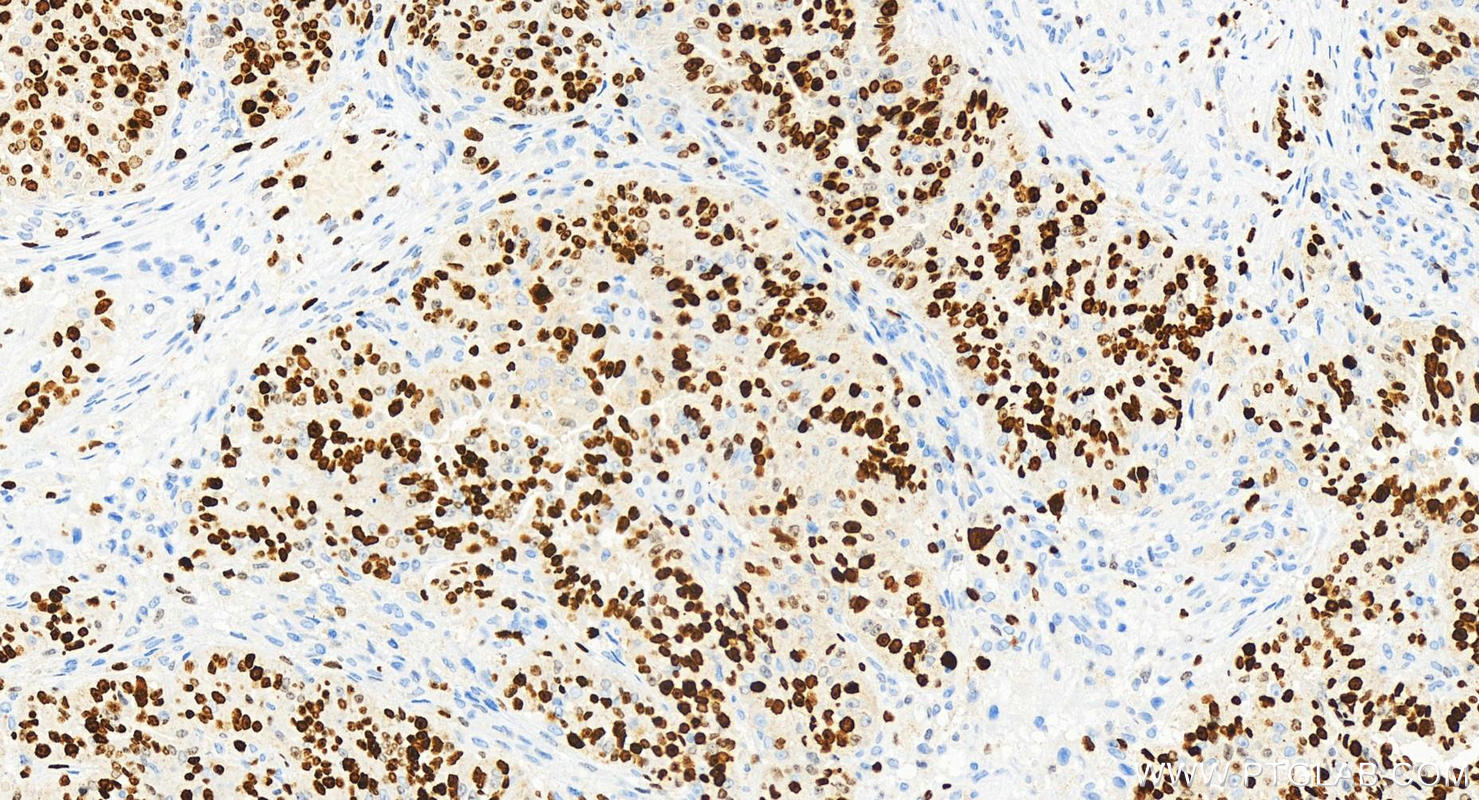 Immunohistochemistry (IHC) staining of human ovarian cancer using KI67 Recombinant antibody (84192-3-RR)