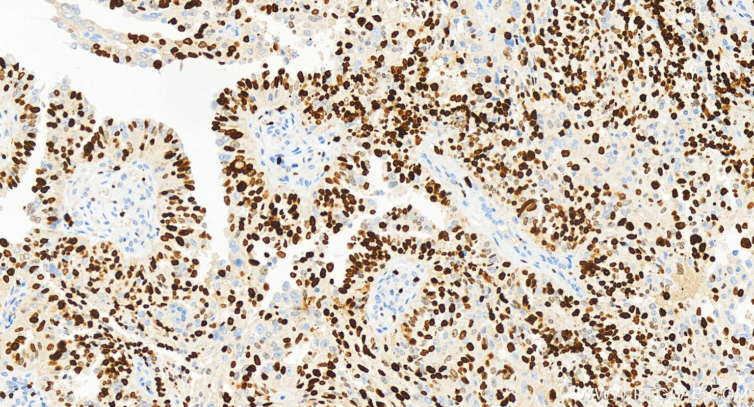 Immunohistochemistry (IHC) staining of human ovarian cancer using KI67 Recombinant antibody (84192-3-RR)