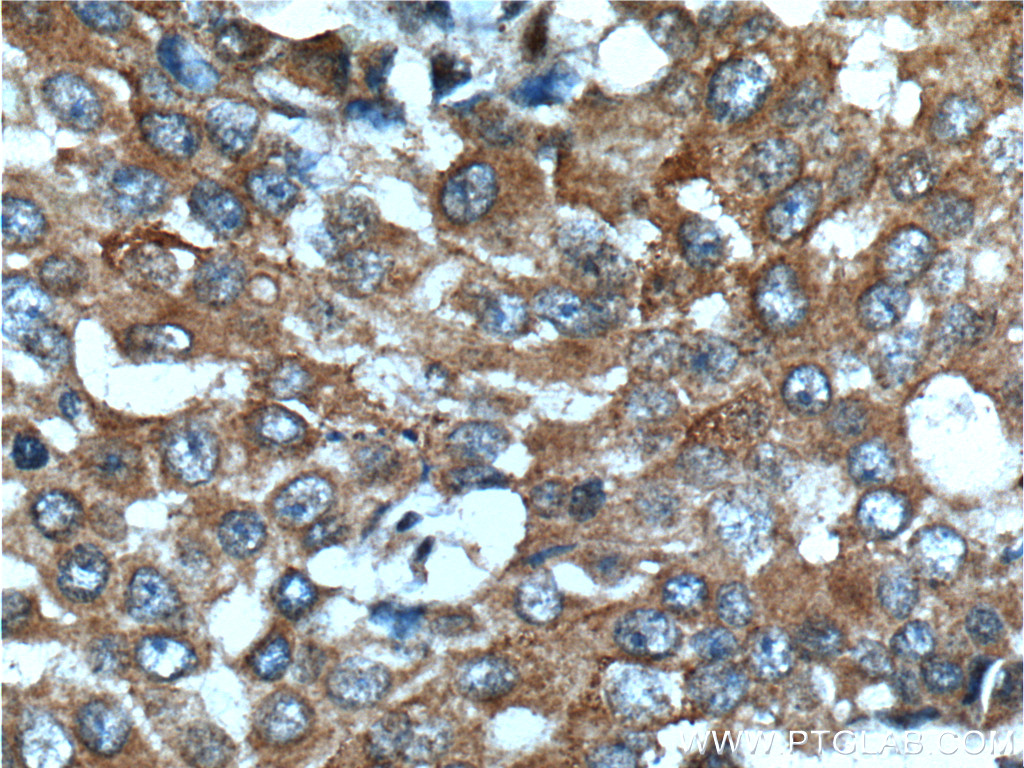 Immunohistochemistry (IHC) staining of human breast cancer tissue using KIAA0090 Polyclonal antibody (26017-1-AP)