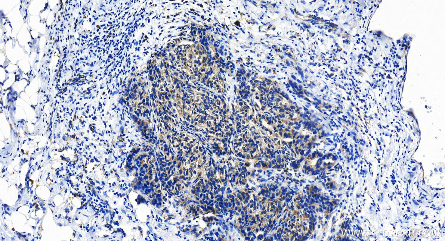 Immunohistochemistry (IHC) staining of human ovary cancer tissue using KIAA0513 Polyclonal antibody (21478-1-AP)