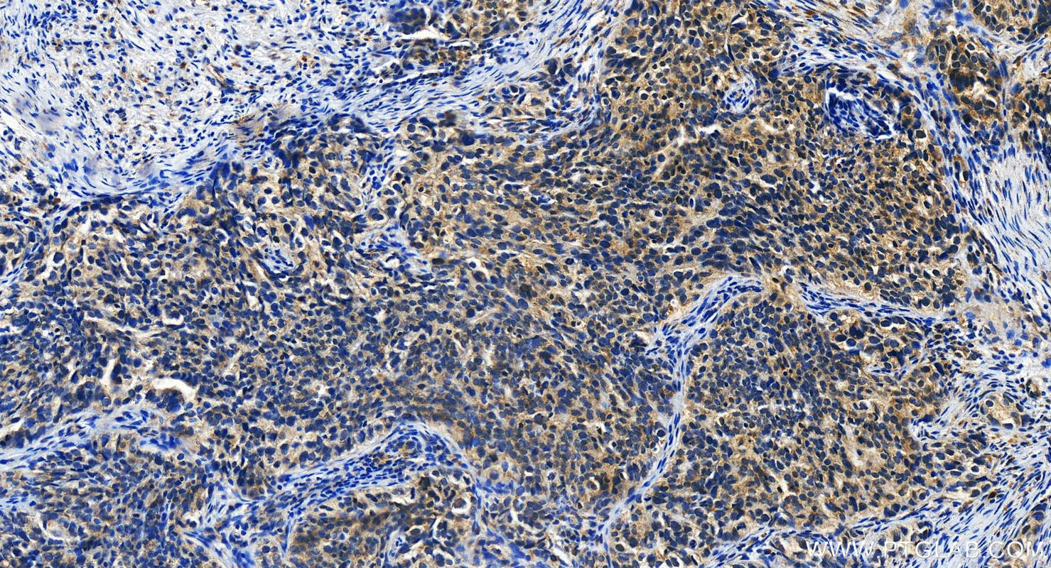 Immunohistochemistry (IHC) staining of human ovary cancer tissue using KIAA0513 Polyclonal antibody (21478-1-AP)