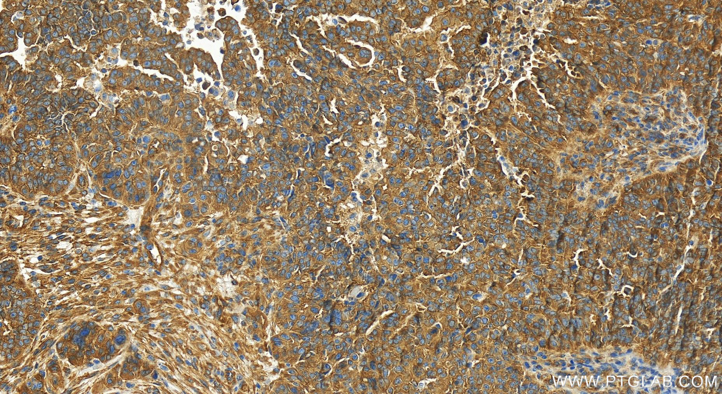 Immunohistochemistry (IHC) staining of human ovarian  cancer using ATG13 Recombinant antibody (82718-3-RR)