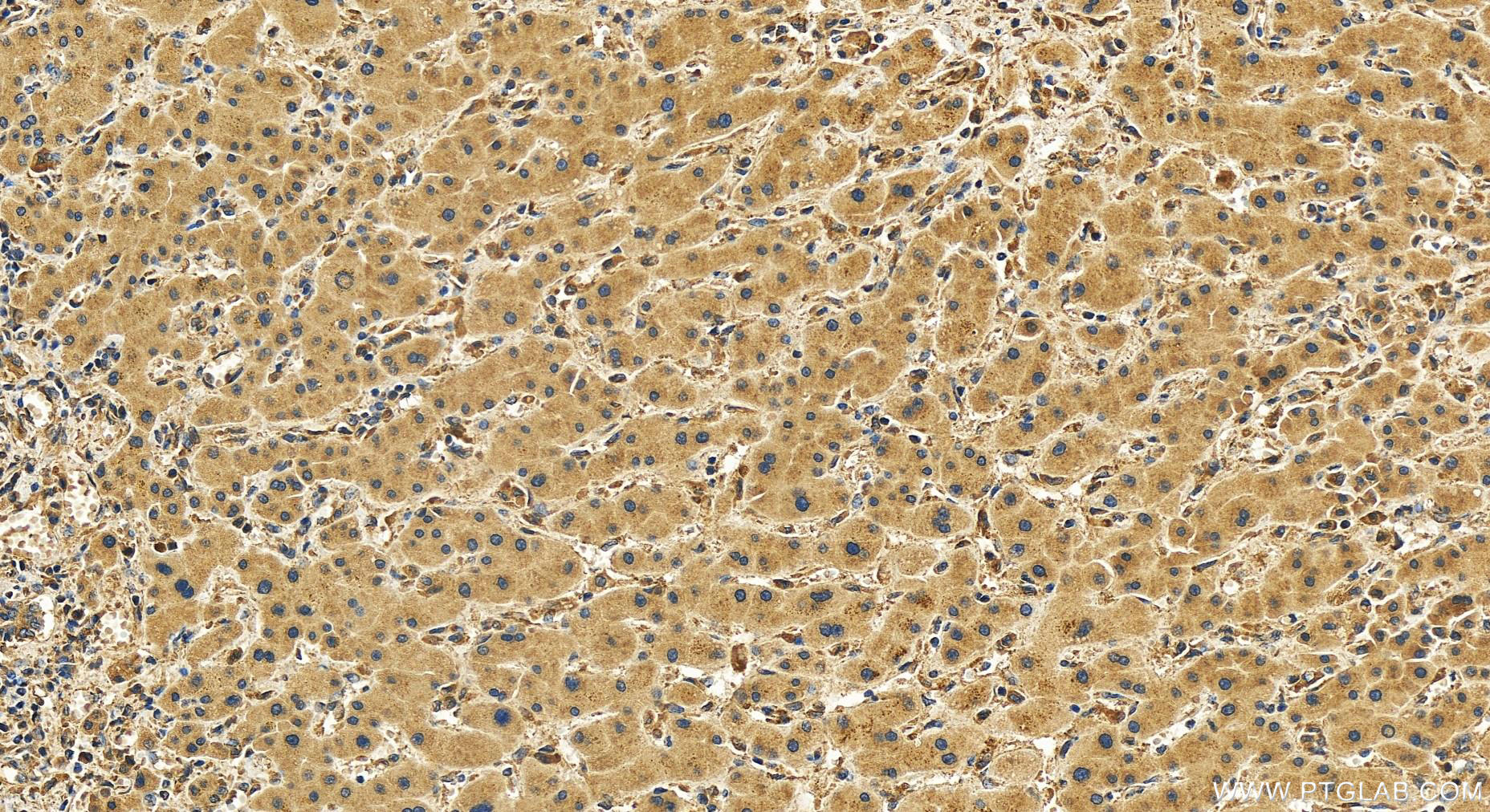 Immunohistochemistry (IHC) staining of human intrahepatic cholangiocarcinoma tissue using KIAA1033 Polyclonal antibody (51101-1-AP)