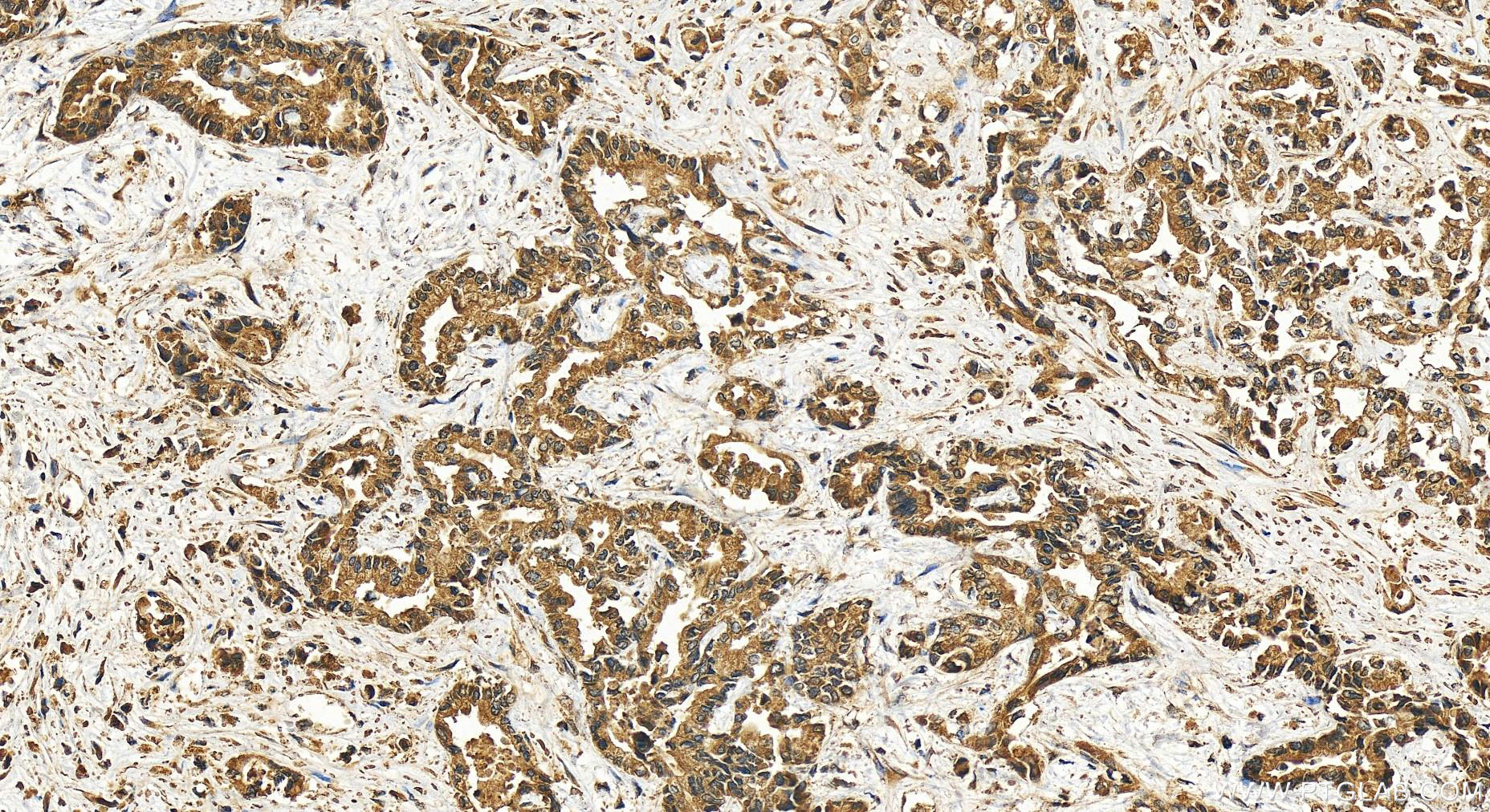 Immunohistochemistry (IHC) staining of human intrahepatic cholangiocarcinoma tissue using KIAA1033 Polyclonal antibody (51101-1-AP)