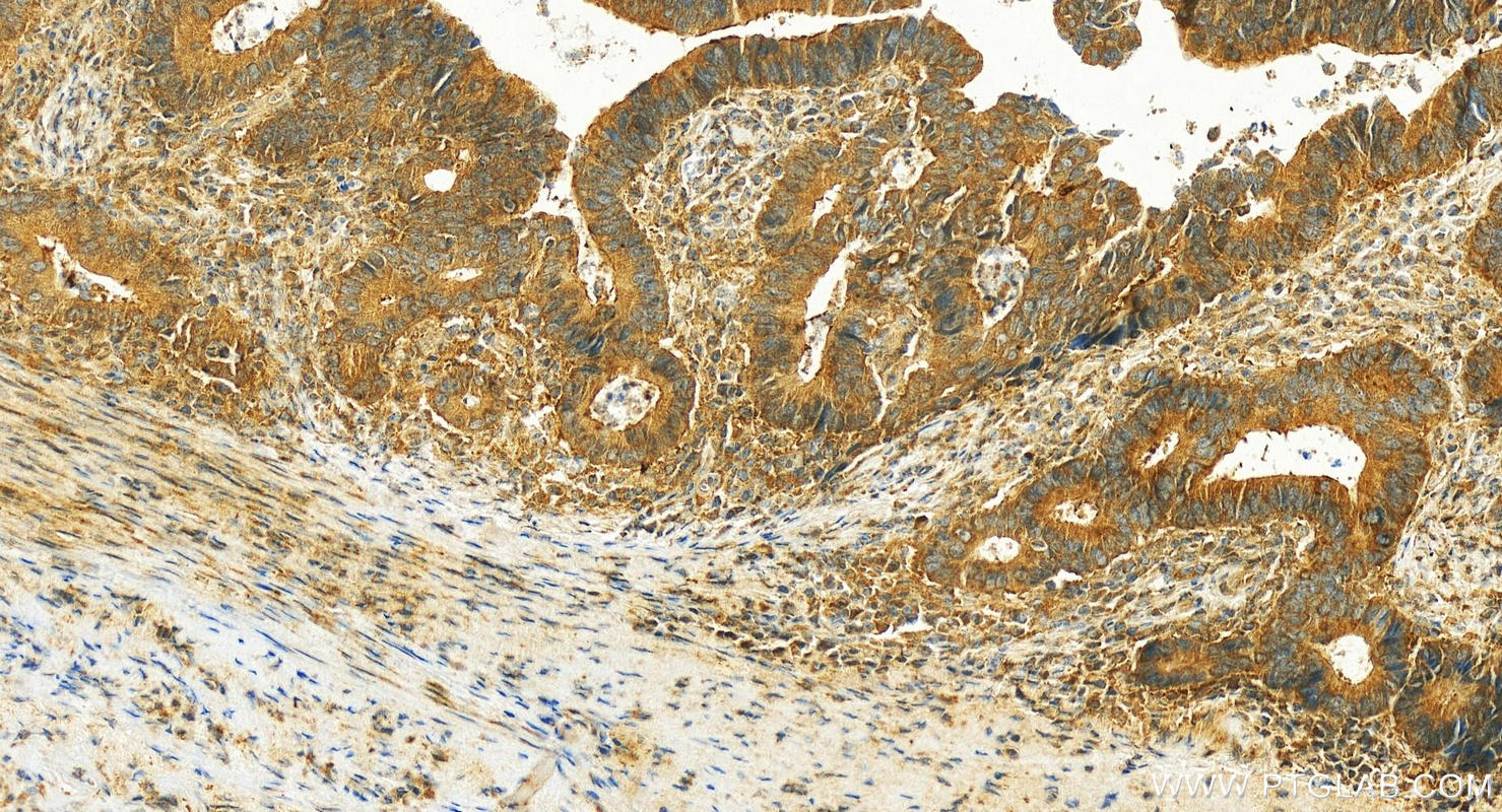 Immunohistochemistry (IHC) staining of human colon  cancer using KIAA1199 / CEMIP  Polyclonal antibody (31106-1-AP)