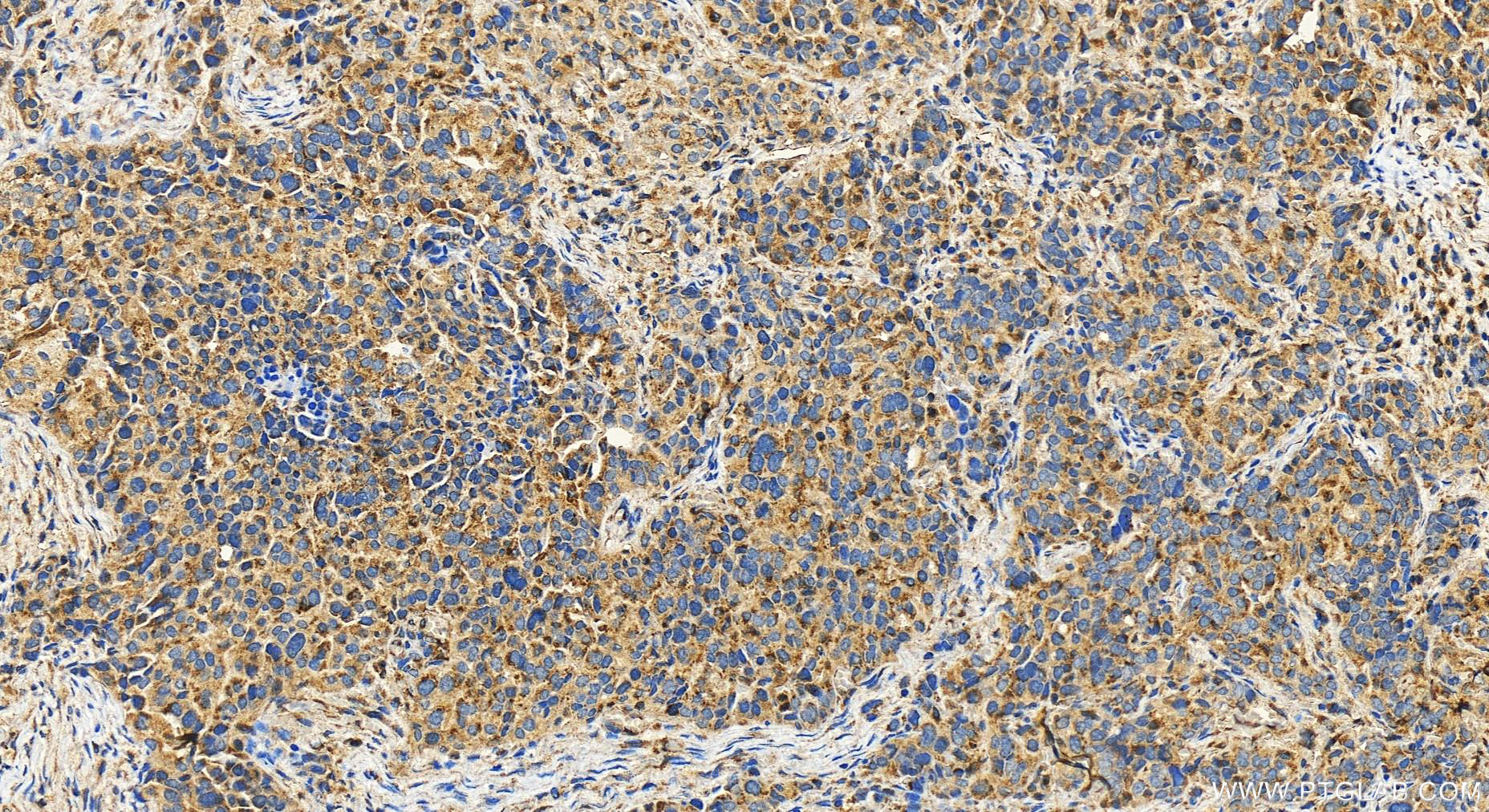 Immunohistochemistry (IHC) staining of human ovary cancer tissue using KIAA2013 Polyclonal antibody (27886-1-AP)