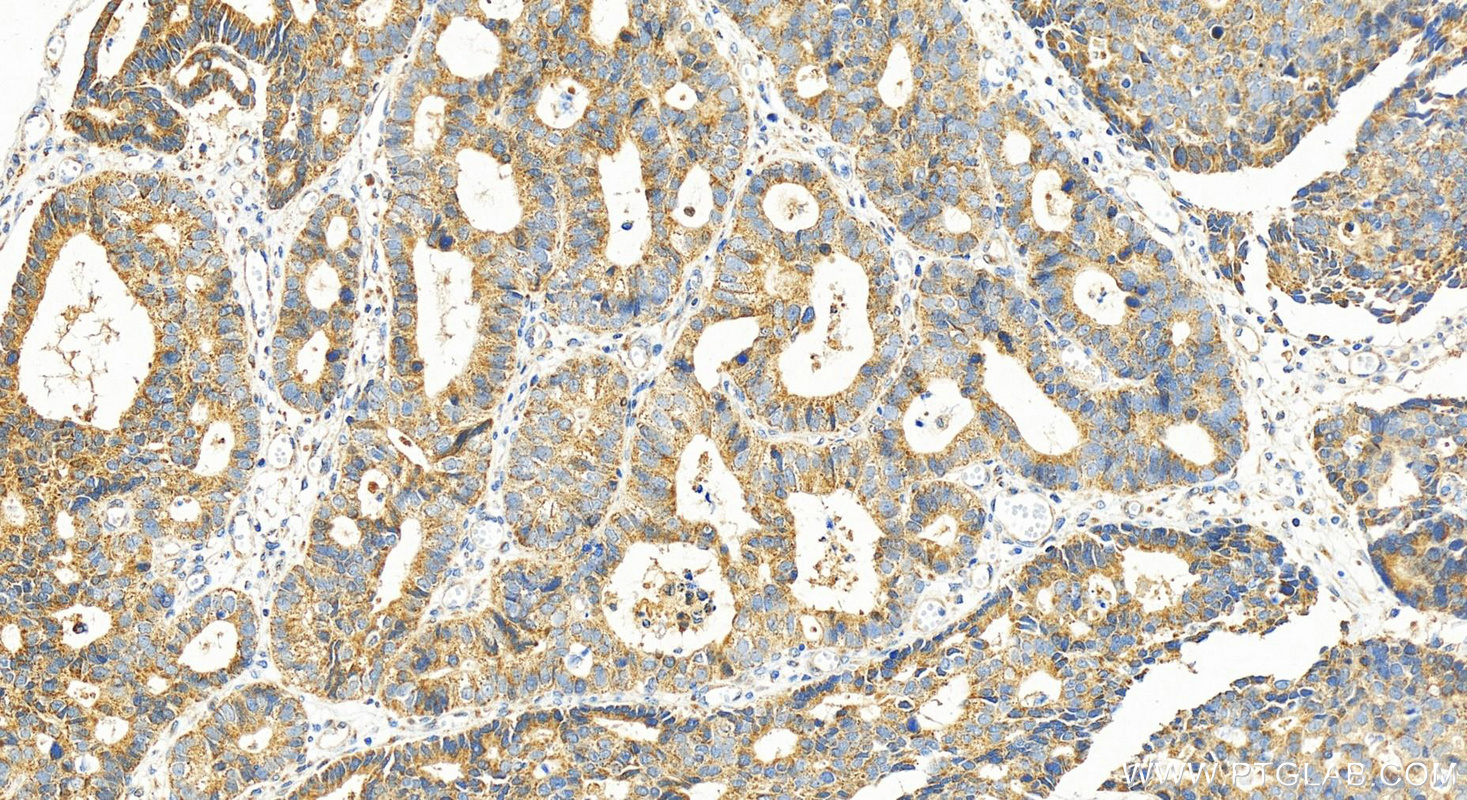 Immunohistochemistry (IHC) staining of human stomach cancer tissue using KIF13B Polyclonal antibody (30141-1-AP)