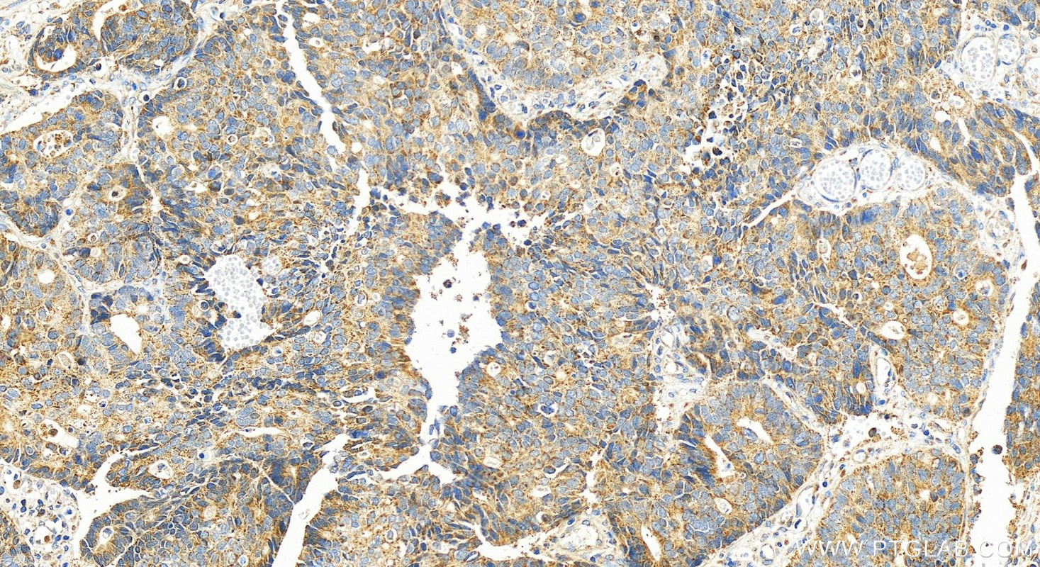 Immunohistochemistry (IHC) staining of human stomach cancer tissue using KIF13B Polyclonal antibody (30141-1-AP)