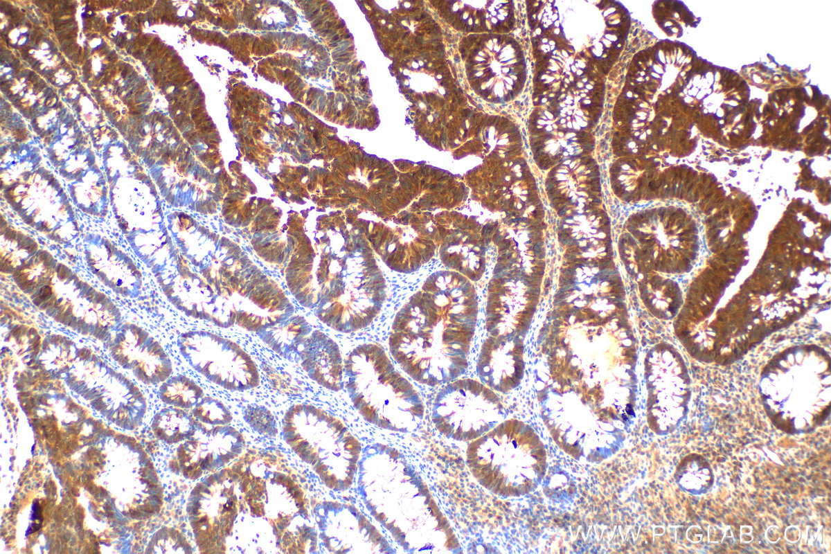 Immunohistochemistry (IHC) staining of human colon  cancer using KIF18A Polyclonal antibody (19245-1-AP)