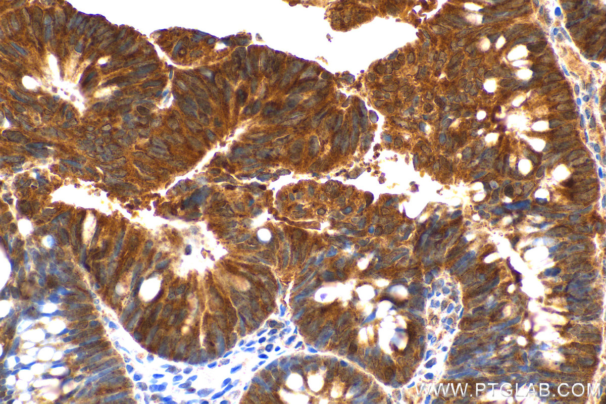 Immunohistochemistry (IHC) staining of human colon  cancer using KIF18A Polyclonal antibody (19245-1-AP)