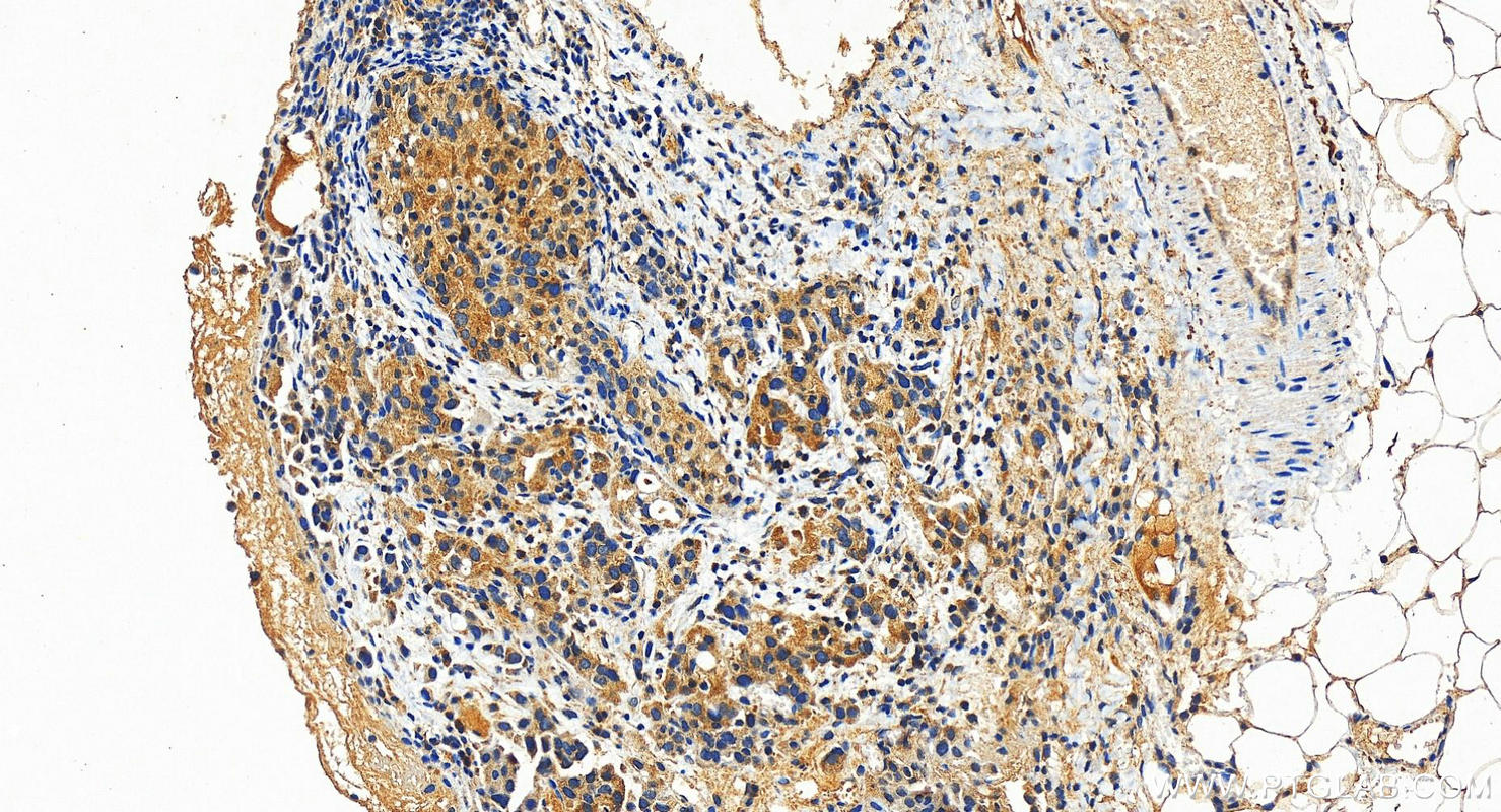 Immunohistochemistry (IHC) staining of human ovary cancer tissue using KIF21A Polyclonal antibody (27276-1-AP)