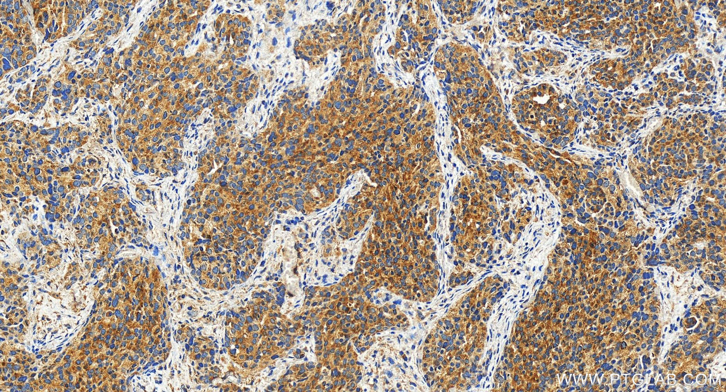 Immunohistochemistry (IHC) staining of human ovary cancer tissue using KIF21A Polyclonal antibody (27276-1-AP)