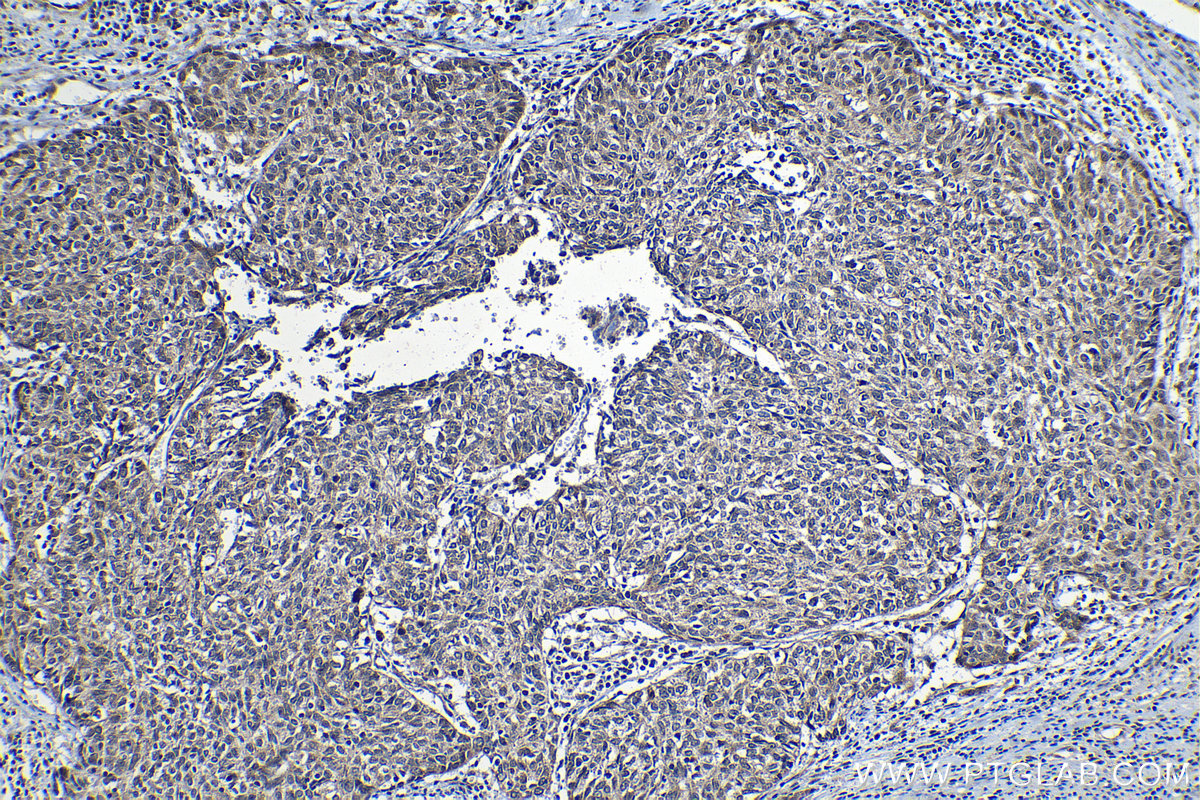 Immunohistochemistry (IHC) staining of human cervical cancer tissue using KIF22 Polyclonal antibody (13403-1-AP)