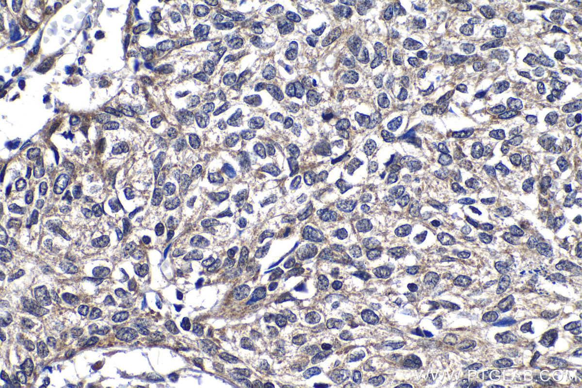 Immunohistochemistry (IHC) staining of human cervical cancer tissue using KIF22 Polyclonal antibody (13403-1-AP)