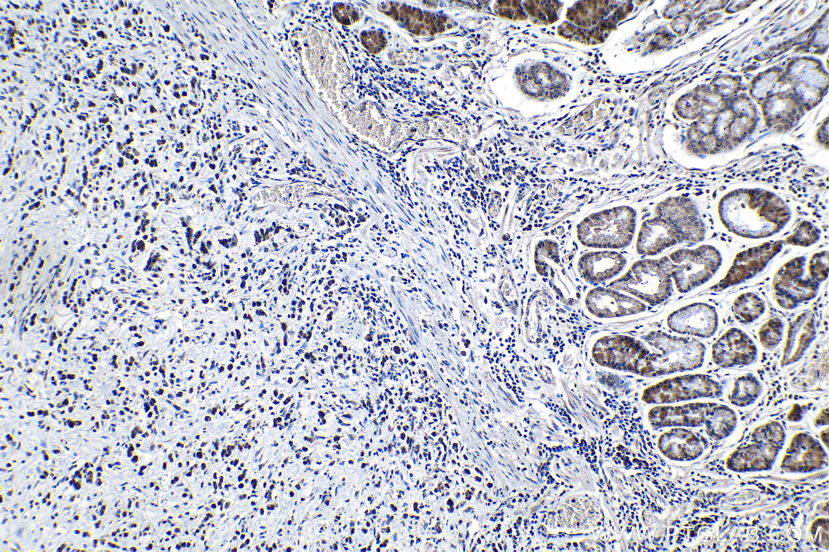 Immunohistochemistry (IHC) staining of human stomach cancer tissue using KIF22 Polyclonal antibody (13403-1-AP)