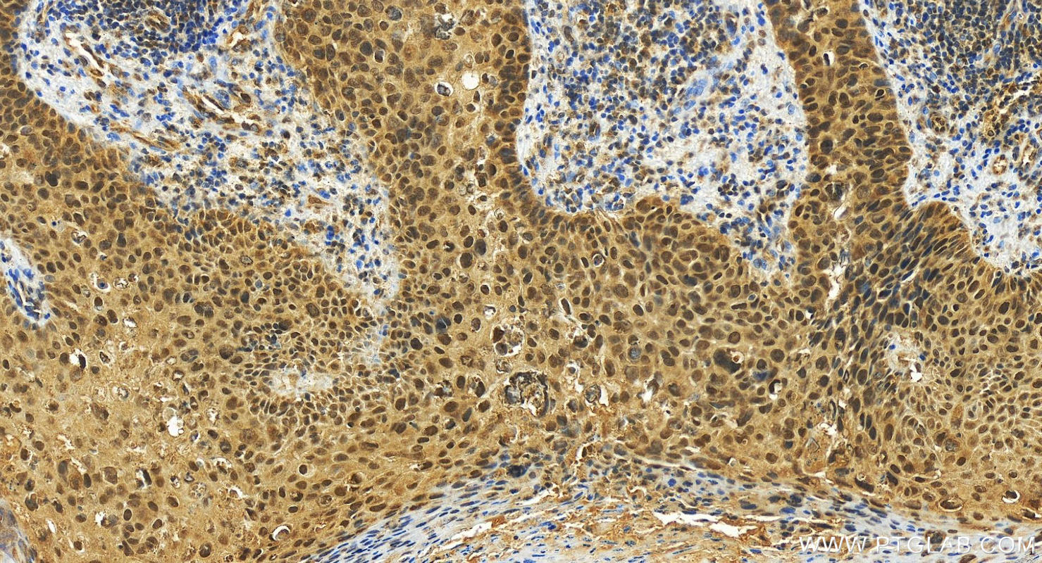 Immunohistochemistry (IHC) staining of human brown disease using KIF22 Polyclonal antibody (13403-1-AP)