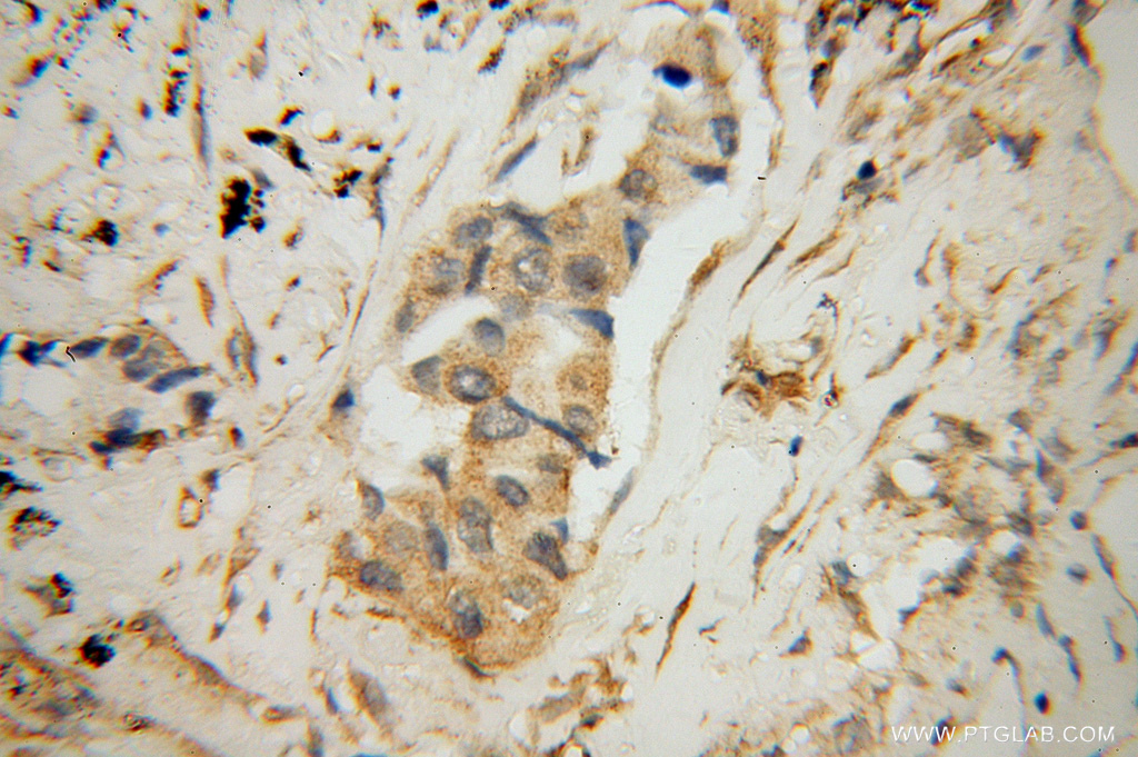 Immunohistochemistry (IHC) staining of human lung cancer tissue using KIF4A Polyclonal antibody (14344-1-AP)