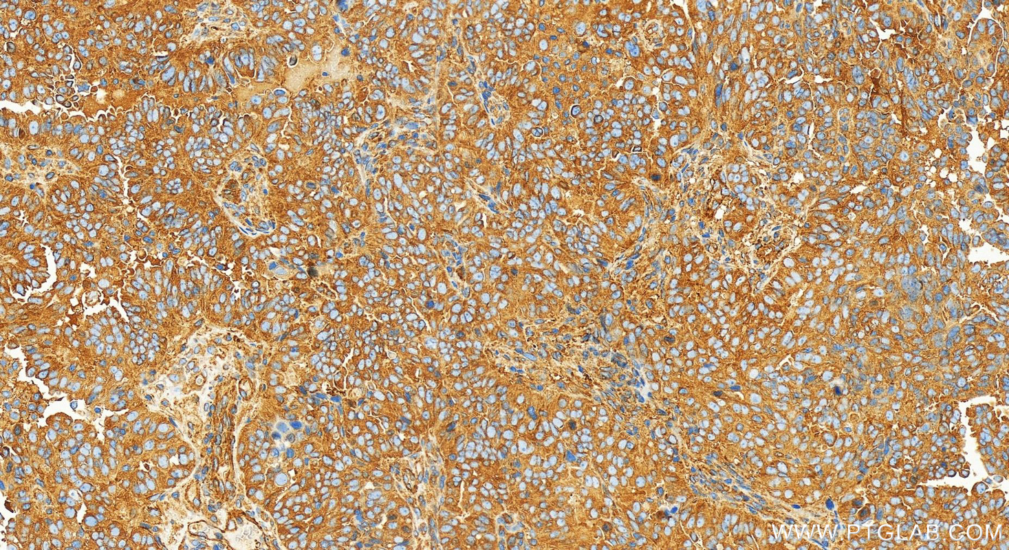 Immunohistochemistry (IHC) staining of human ovarian  cancer using KIF5B Recombinant antibody (82485-1-RR)