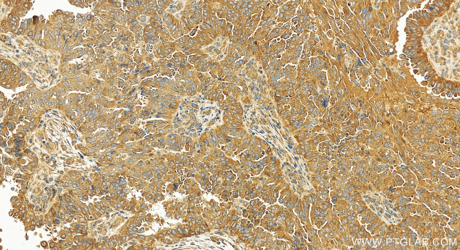 Immunohistochemistry (IHC) staining of human ovary cancer tissue using KIFAP3 Polyclonal antibody (12700-1-AP)