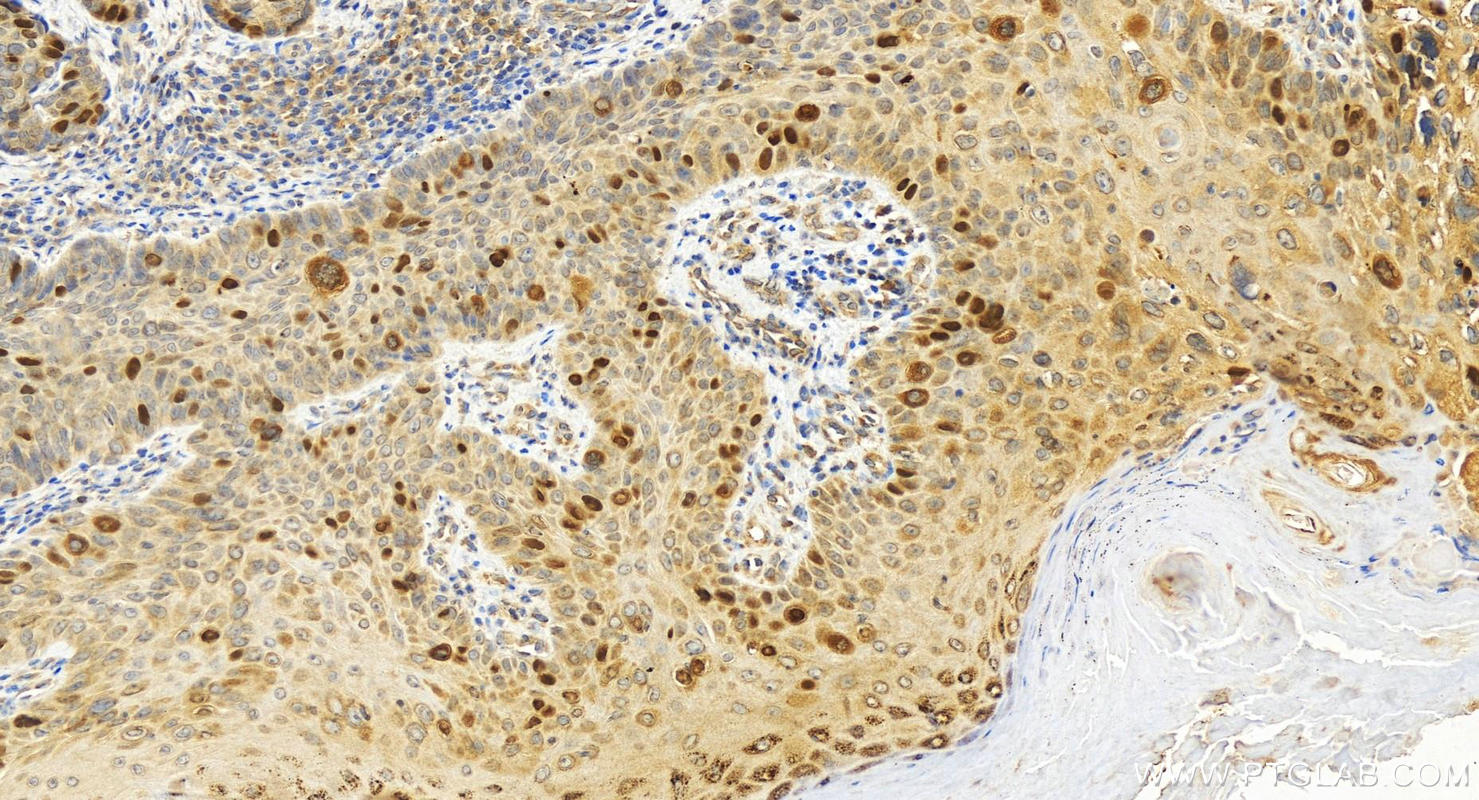 Immunohistochemistry (IHC) staining of human bowen disease using KIFC1 Polyclonal antibody (20790-1-AP)