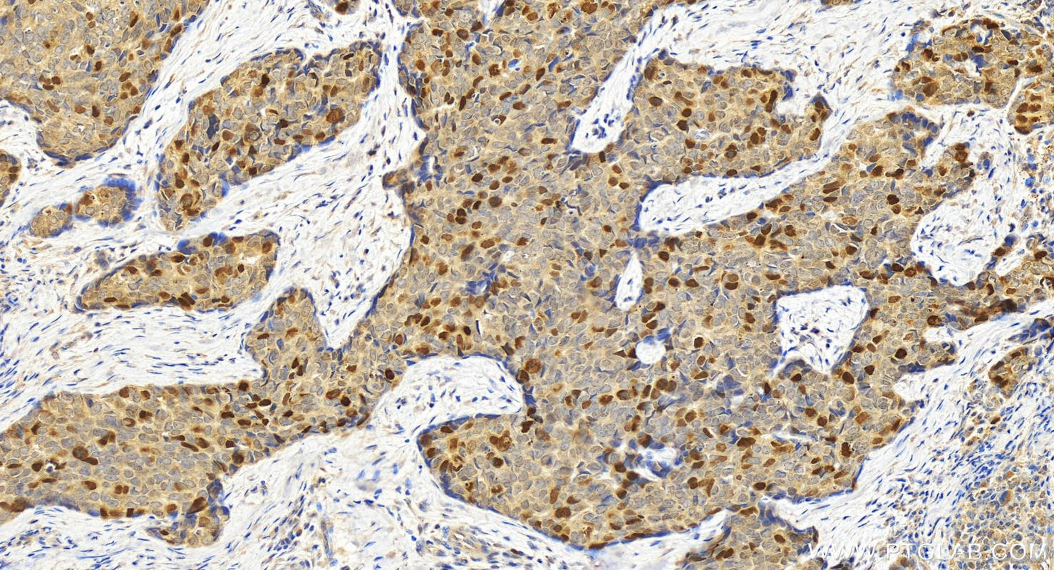 Immunohistochemistry (IHC) staining of human bowen disease using KIFC1 Polyclonal antibody (20790-1-AP)