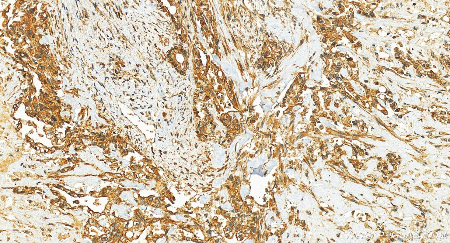 Immunohistochemistry (IHC) staining of human intrahepatic cholangiocarcinoma tissue using KIFC3 Polyclonal antibody (10125-2-AP)