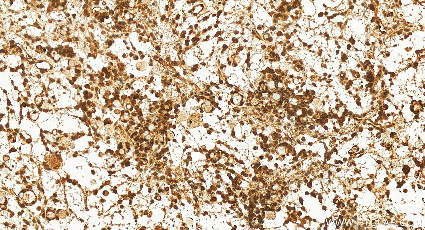 Immunohistochemistry (IHC) staining of human ovary cancer tissue using KIN17 Polyclonal antibody (12313-1-AP)