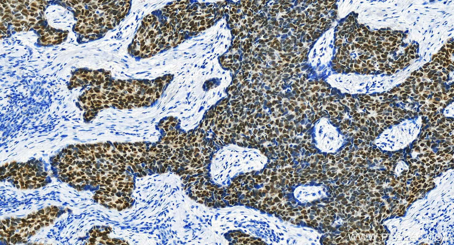 Immunohistochemistry (IHC) staining of human bowen disease using KLF5 Polyclonal antibody (21017-1-AP)