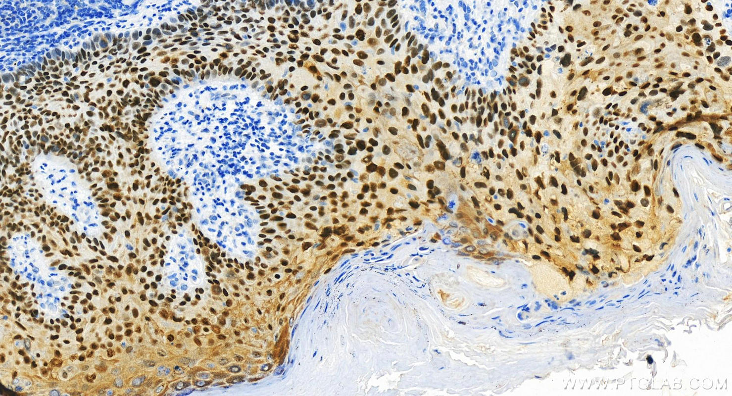 Immunohistochemistry (IHC) staining of human bowen disease using KLF5 Polyclonal antibody (21017-1-AP)