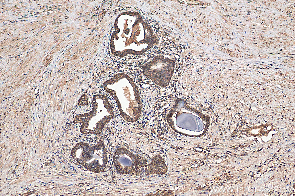 Immunohistochemistry (IHC) staining of human prostate cancer tissue using KLHL15 Polyclonal antibody (25066-1-AP)