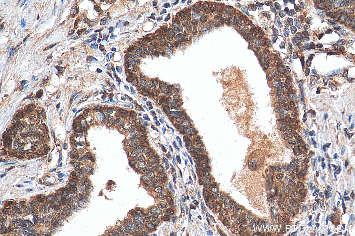 Immunohistochemistry (IHC) staining of human prostate cancer tissue using KLHL15 Polyclonal antibody (25066-1-AP)