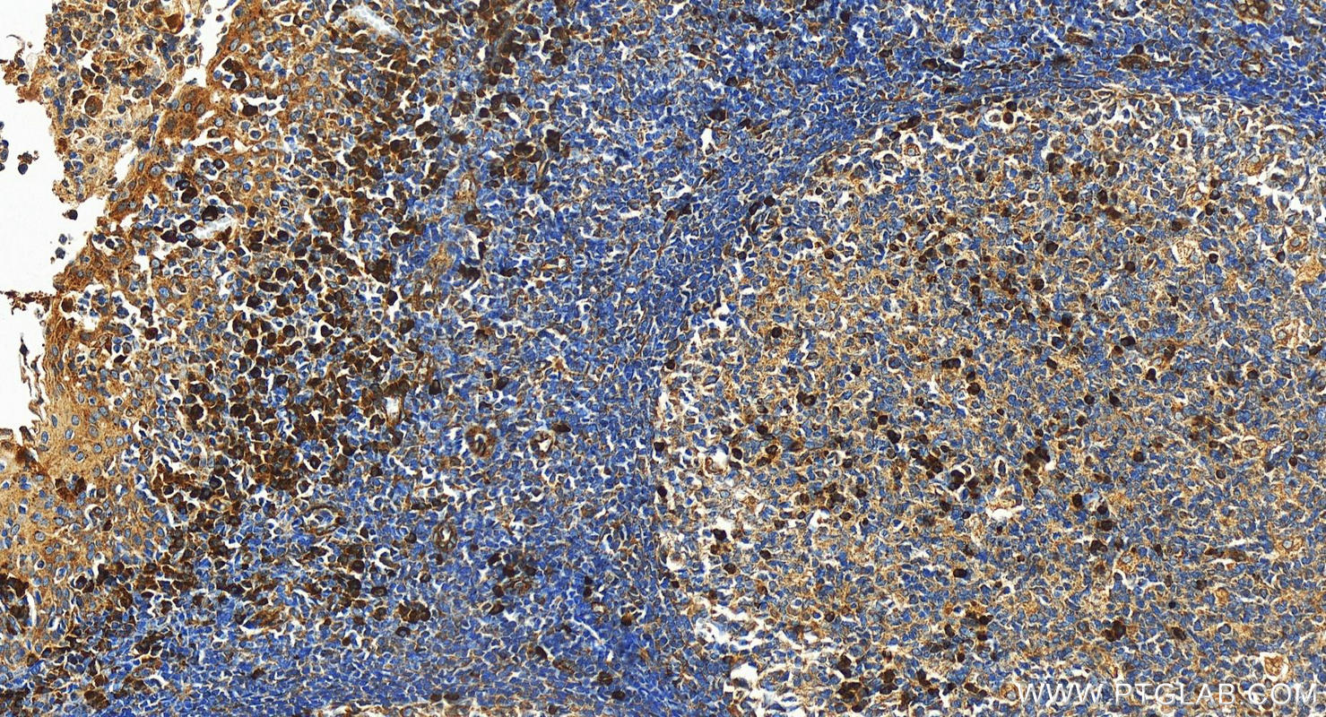 Immunohistochemistry (IHC) staining of human tonsillitis tissue using KLHL3 Polyclonal antibody (16951-1-AP)