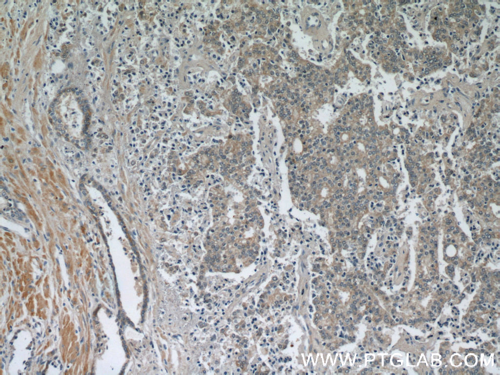 Immunohistochemistry (IHC) staining of human prostate cancer tissue using Kallikrein 11 Polyclonal antibody (12698-1-AP)