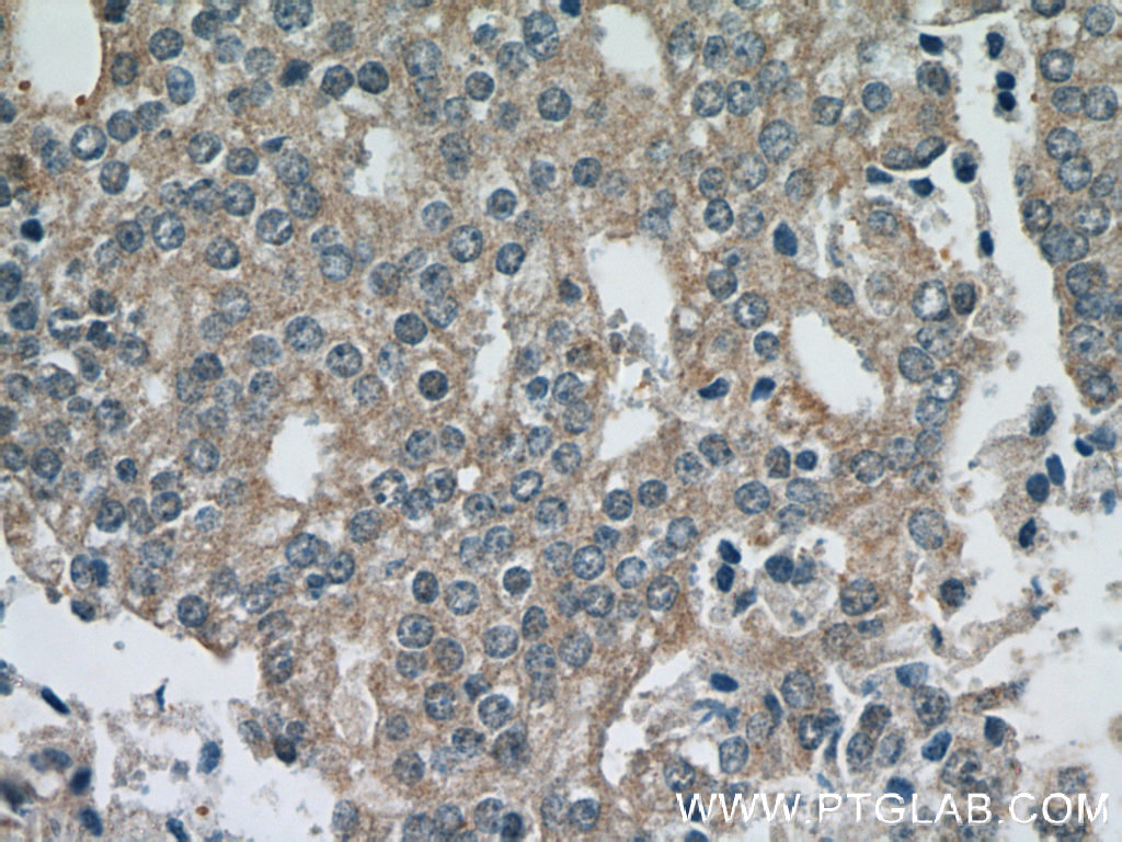 Immunohistochemistry (IHC) staining of human prostate cancer tissue using Kallikrein 11 Polyclonal antibody (12698-1-AP)