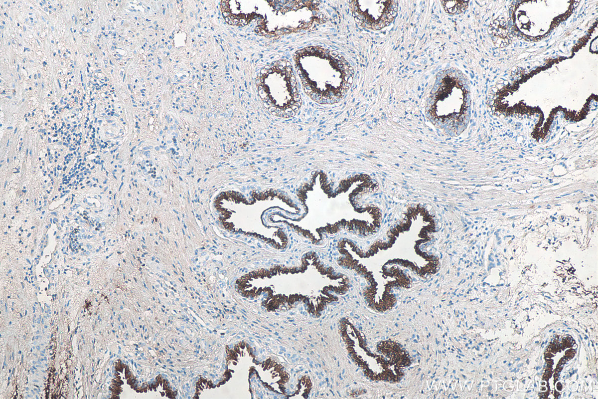 Immunohistochemistry (IHC) staining of human prostate cancer tissue using KLK3/PSA Monoclonal antibody (60338-1-Ig)