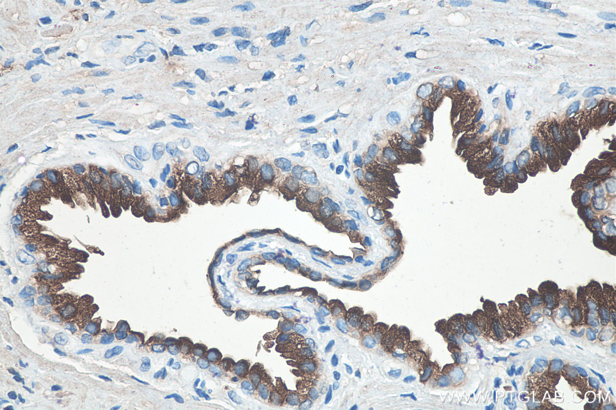 Immunohistochemistry (IHC) staining of human prostate cancer tissue using KLK3/PSA Monoclonal antibody (60338-1-Ig)