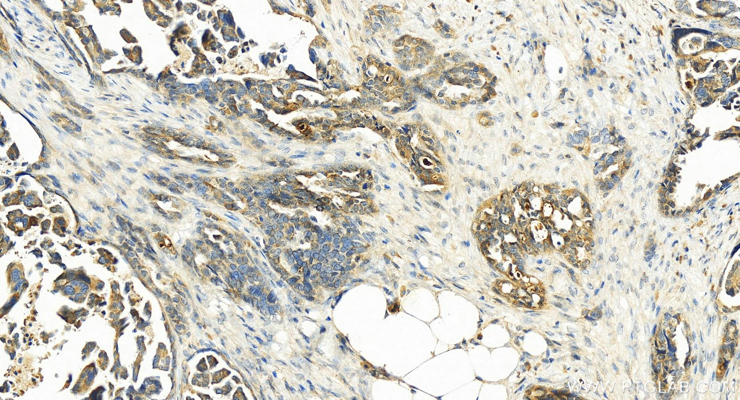 Immunohistochemistry (IHC) staining of human ovary cancer tissue using Kallikrein 8 Polyclonal antibody (14232-1-AP)