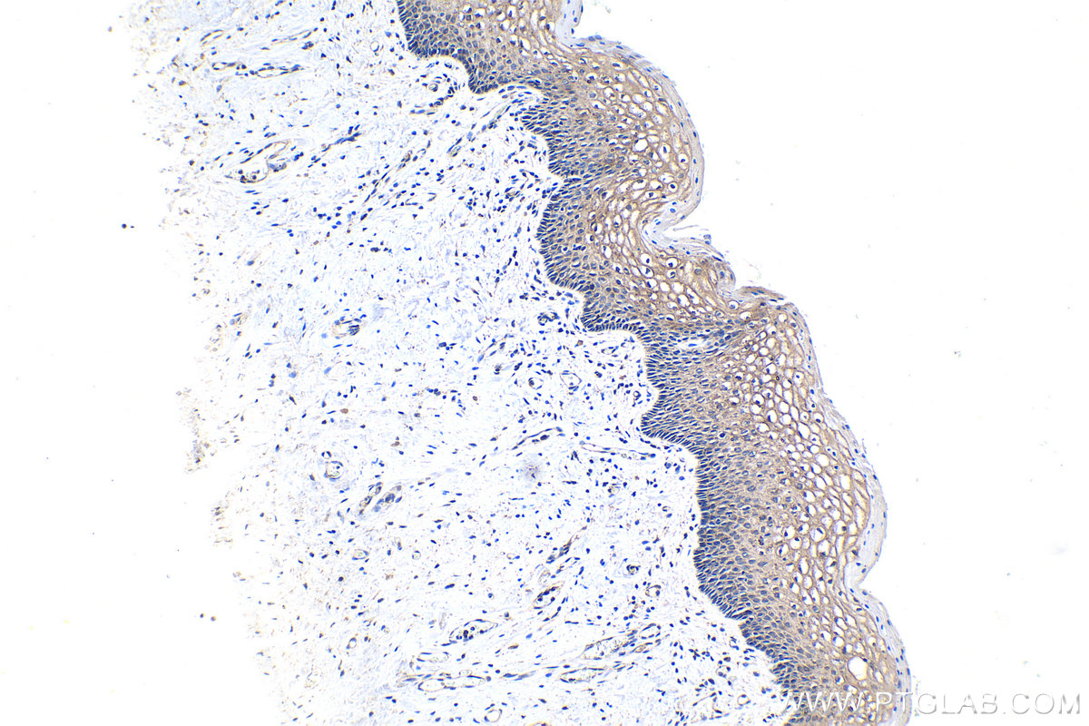 Immunohistochemistry (IHC) staining of human cervical cancer tissue using KLK8 Monoclonal antibody (68247-1-Ig)