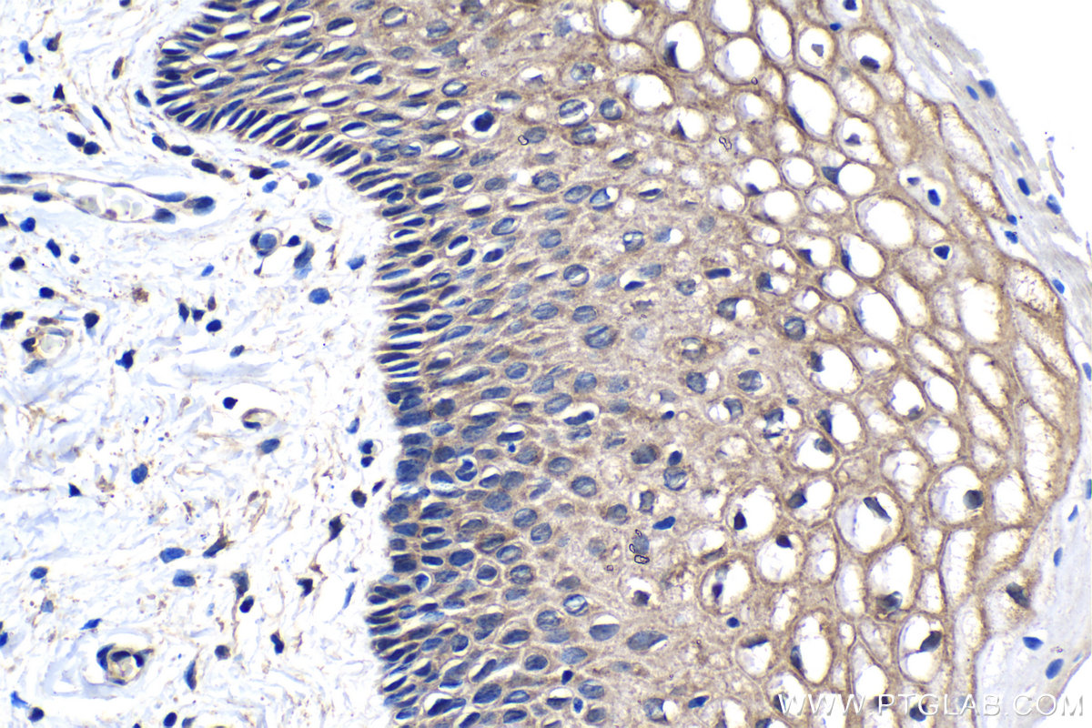 Immunohistochemistry (IHC) staining of human cervical cancer tissue using KLK8 Monoclonal antibody (68247-1-Ig)