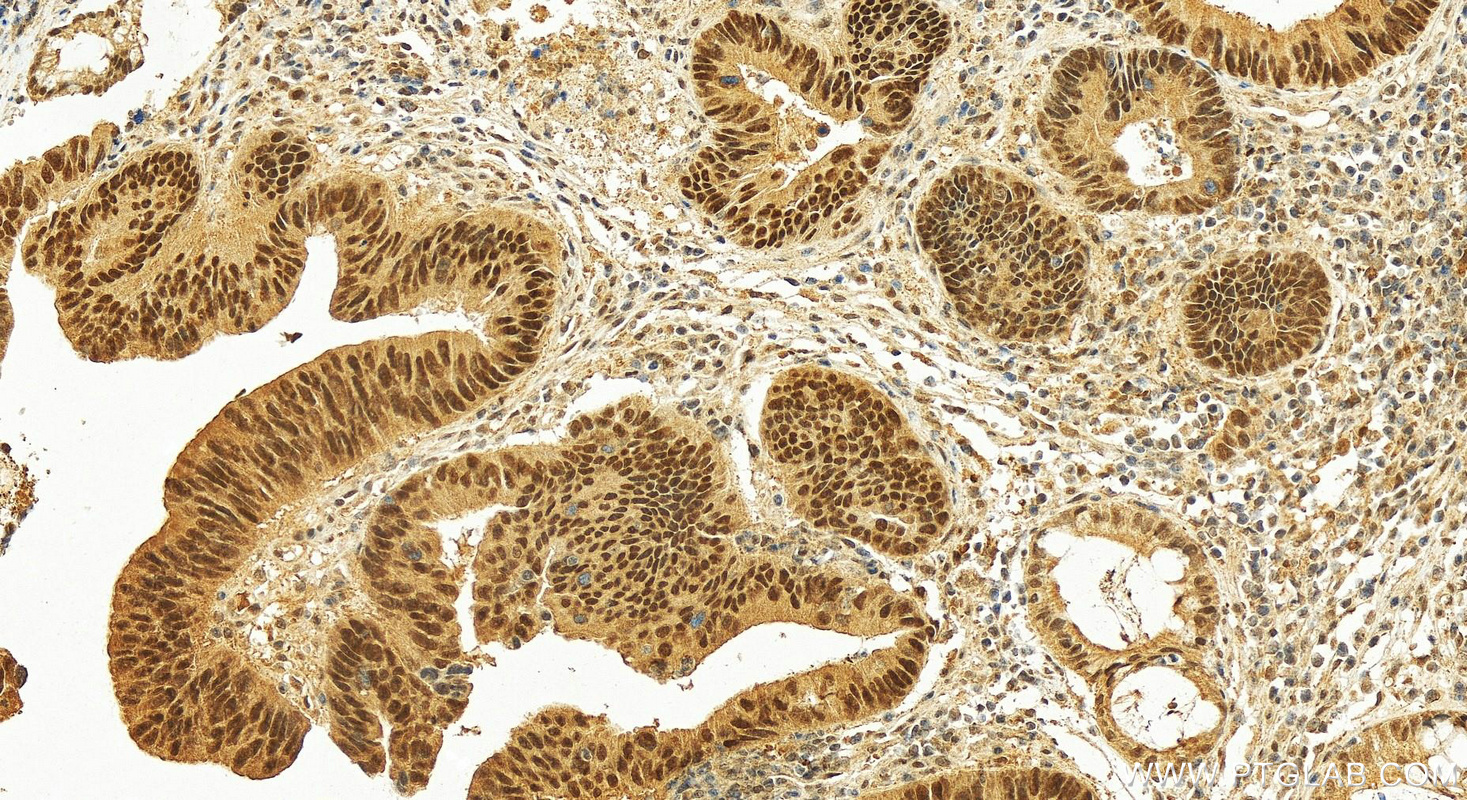 Immunohistochemistry (IHC) staining of human colon cancer tissue using KMT2D Polyclonal antibody (27266-1-AP)