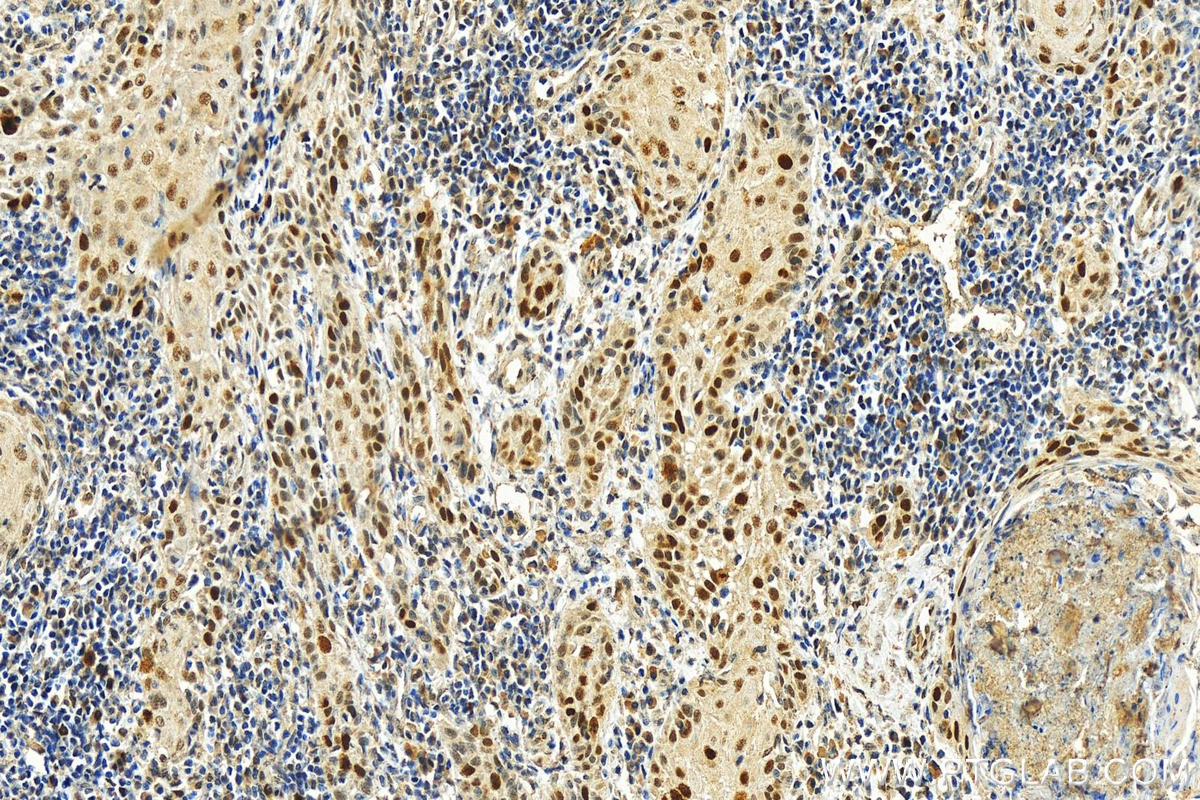 Immunohistochemistry (IHC) staining of human skin cancer tissue using KPNA2 Monoclonal antibody (66870-1-Ig)