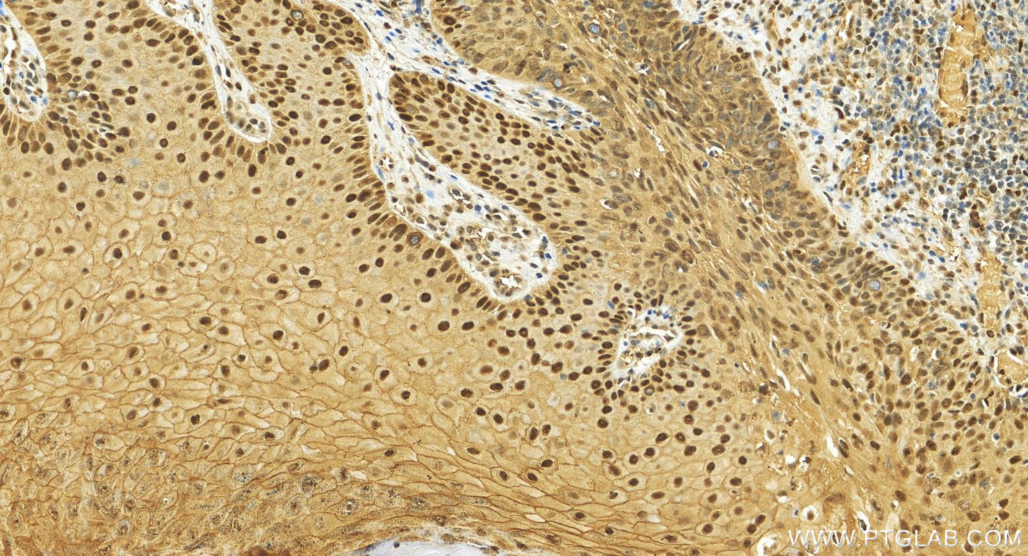 Immunohistochemistry (IHC) staining of human brown disease using KPNA3 Polyclonal antibody (28050-1-AP)