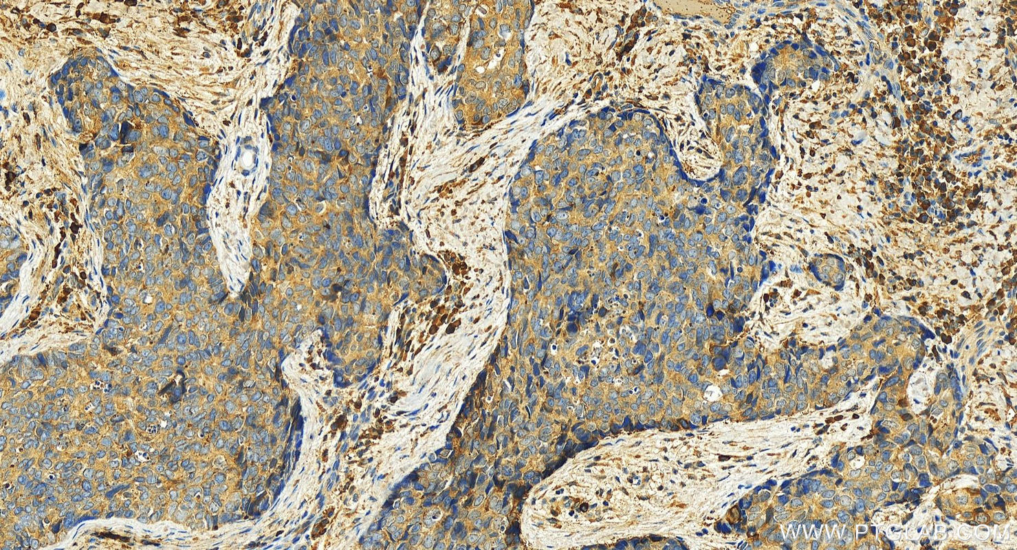 Immunohistochemistry (IHC) staining of human bowen disease using KPNA4 Polyclonal antibody (12463-1-AP)