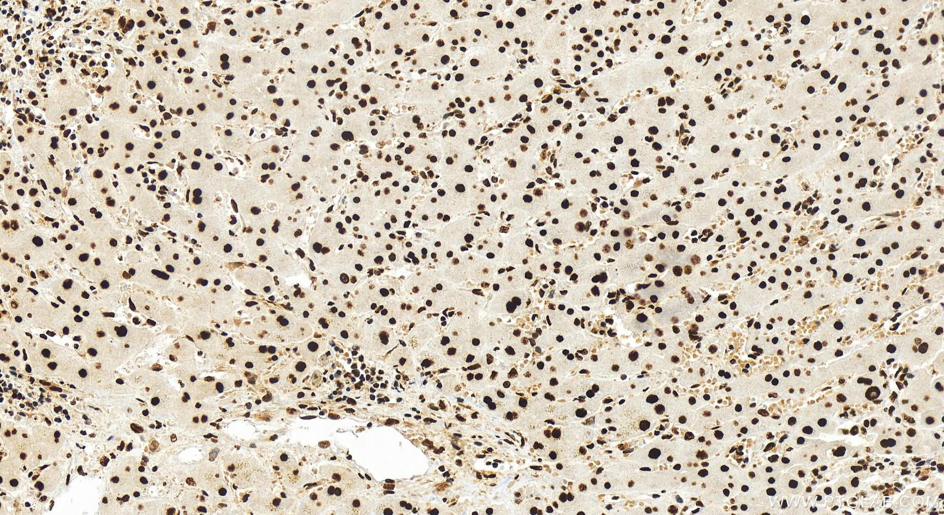 Immunohistochemistry (IHC) staining of human intrahepatic cholangiocarcinoma tissue using KPNA4 Recombinant antibody (82898-2-RR)