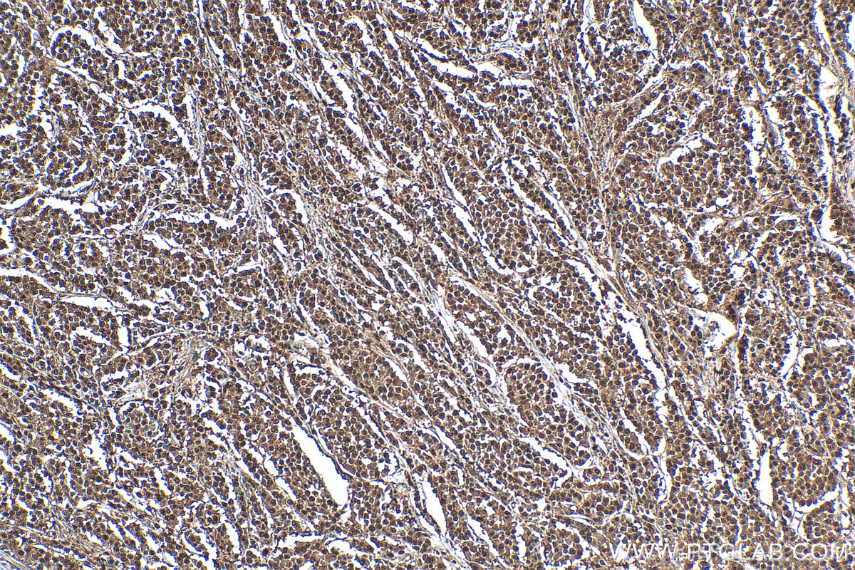 Immunohistochemistry (IHC) staining of human colon cancer tissue using Importin Beta Polyclonal antibody (10077-1-AP)