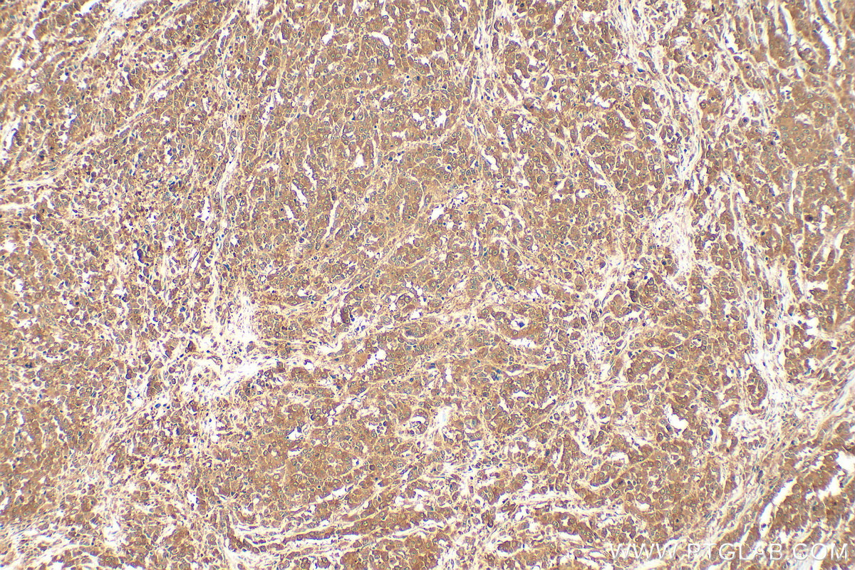 Immunohistochemistry (IHC) staining of human colon cancer tissue using KRAS Polyclonal antibody (12063-1-AP)