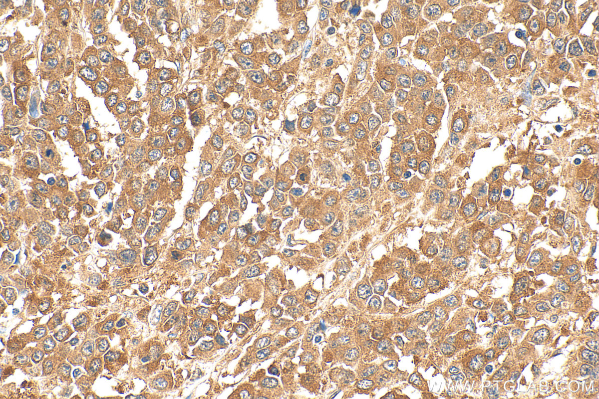 Immunohistochemistry (IHC) staining of human colon cancer tissue using KRAS Polyclonal antibody (12063-1-AP)